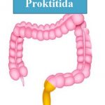 Proktitida (zánět konečníku) – příznaky, příčiny a léčba