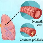 Přírodní léčba bronchitidy – jak na to?