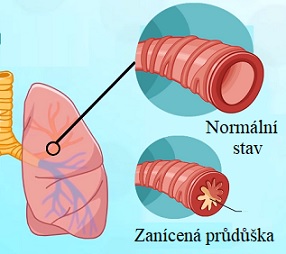 Bronchitida se dá léčit i pomocí přírodních postupů.