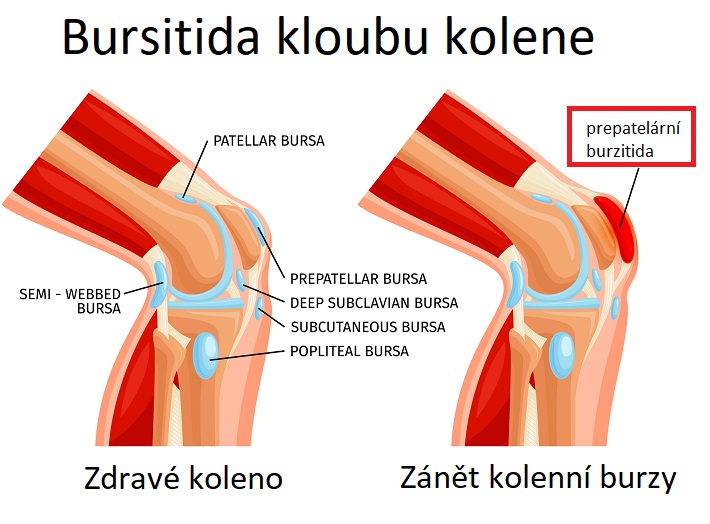 Bursitida kolene - ILUSTRACE