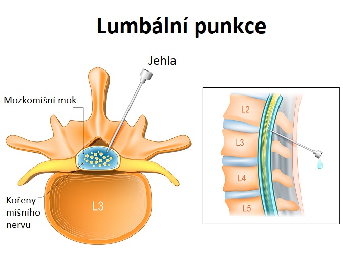 Lumbální punkce (vyšetření mozkomíšního moku - ilustrace