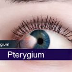 Pterygium neboli surfařovo oko – příznaky, příčiny a léčba