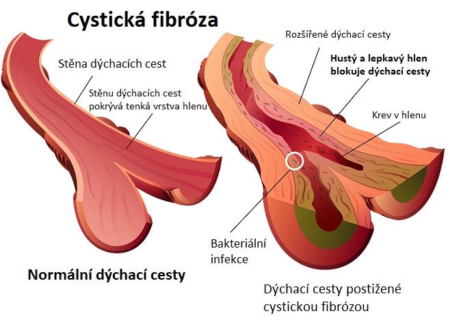 Cystická fibróza - ilustrace