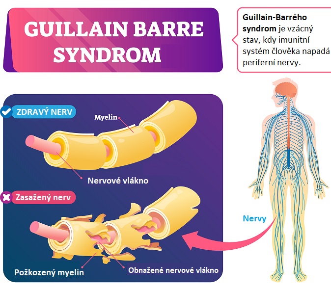 Guillain-Barrého syndrom je vzácný stav, kdy imunitní systém člověka napadá periferní nervy.