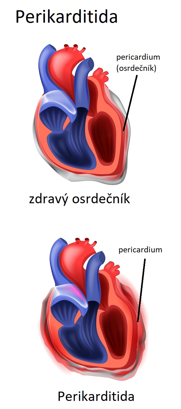 Perikarditida - ilustrace