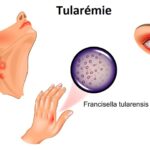 Tularémie u dětí – příznaky, příčiny a léčba