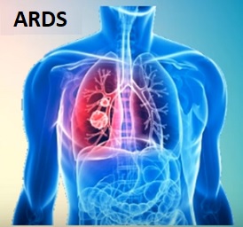 ARDS, nebo syndrom akutní respirační tísně, je plicní onemocnění, které vede k nízké hladině kyslíku v krvi.