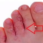 Atletická noha (tinea pedis) – příznaky, příčiny a léčba
