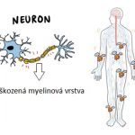 Guillain-barrého syndrom – příznaky, příčiny a léčba