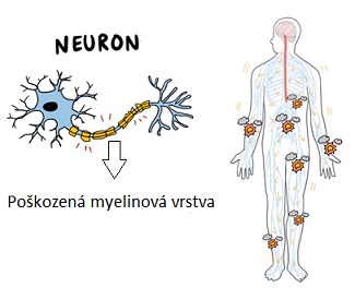 U nejčastější formy Guillain-Barre syndromu, je poškozen ochranný obal nervů (myelinový plášť).