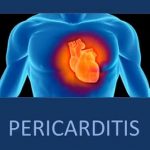 Perikarditida (zánět osrdečníku) – příznaky, příčiny a léčba