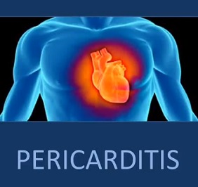 Perikarditida neboli zánět osrdečníku je onemocnění často zaměňované s infarktem myokardu.