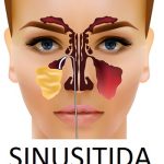 Sinusitida (zánět dutin) – příznaky, příčiny a léčba