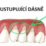 Jak na ustupující dásně? Zkuste tyto domácí metody