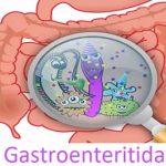 Žaludeční chřipka (gastroenteritida) – příznaky, příčiny a léčba