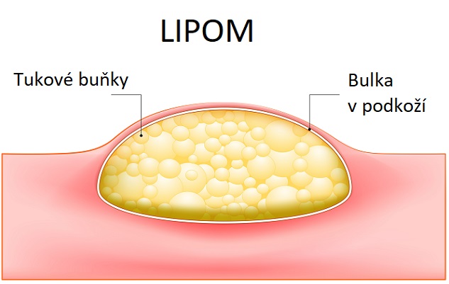 Lipom je nezhoubný nádor tvořený tukovými buňkami, který se nejčastěji vyskytuje v podkoží.