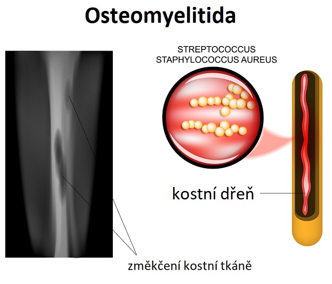 Osteomyelitida - ilustrace