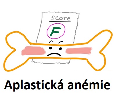 Aplastická anemie znamená chudokrevnost, která má původ v nedostatečné tvorbě krvinek v kostní dřeni.