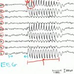 Elektroencefalografie (EEG) – co je to a co znamenají výsledky?