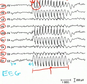 EEG měří elektrické impulsy v mozku pomocí několika elektrod, které jsou připojeny k pokožce hlavy.