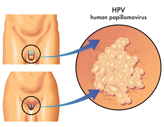 Genitální bradavice - ilustrace