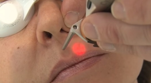 Chloupky pod nosem efektivně vyřeší laser.