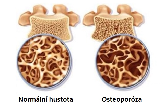 Hustota zdravé kosti a při osteoporóze.