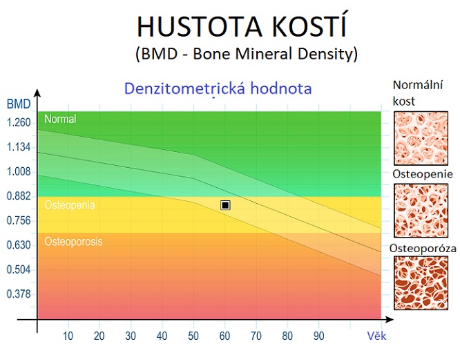 Hustota kostí - osteopenie x osteoporóza