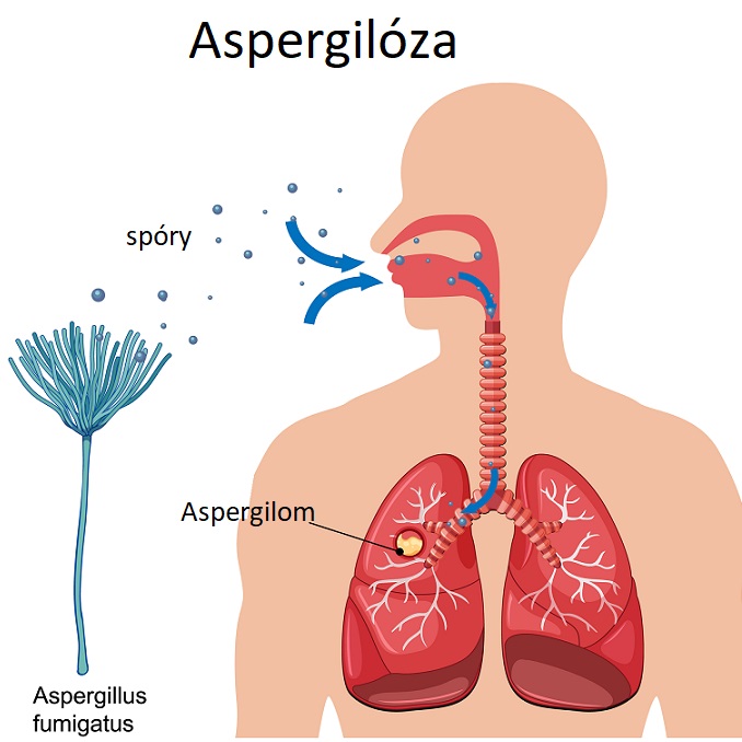 Aspergilóza - ilustrace