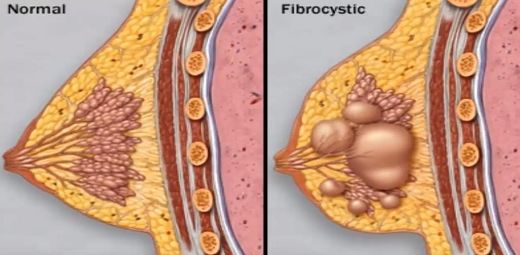 Porovnání normální a fibrocystická tkáň