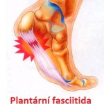 Plantární fasciitida způsobuje bolest v oblasti paty – příznaky, příčiny a léčba
