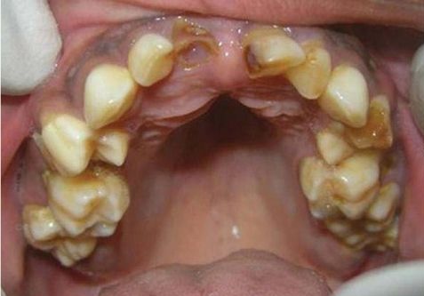 Abnormality zubů jsou také jedním z příznaků syndromu.