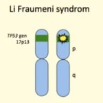 Syndrom Li-Fraumeni – příznaky a příčiny