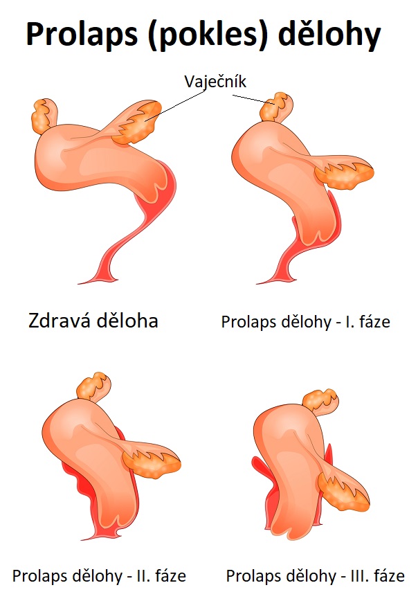 Prolaps (pokles) dělohy - ilustrace