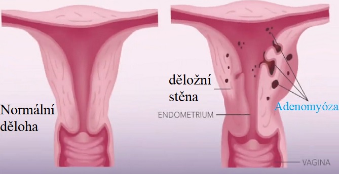 Poprvé byla adenomyóza popsána v roce 1860. Je běžnou benigní děložní abnormalitou.