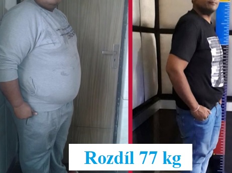 Bariatrická chirurgie pomáhá lidem se závažnou obezitou.