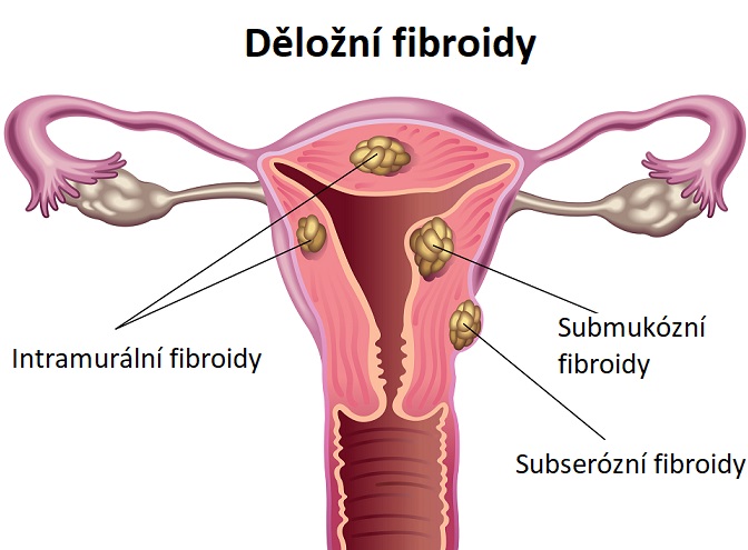 Děložní fibroidy (myomy) - ilustrace