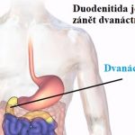 Duodenitida neboli zánět dvanáctníku – příznaky, příčiny a léčba