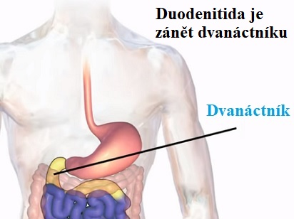 Duodenitida - příznaky, příčiny a léčba