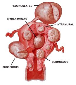 Druhy děložních fibroidů na obrázku