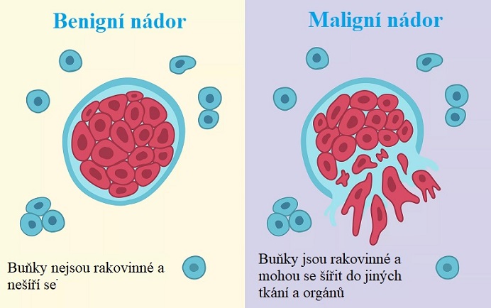 Maligní vs. benigní nádory - vysvětlení pomocí obrázku