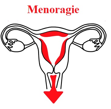 Menoragie - jaké jsou příznaky, příčiny a jak se léčí?