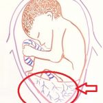 Placenta previa (vcestné lůžko) – příznaky, příčiny a léčba