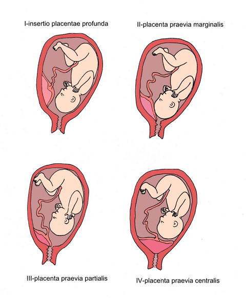 Obrázkem vysvětlené jednotlivé typy placenta previa.