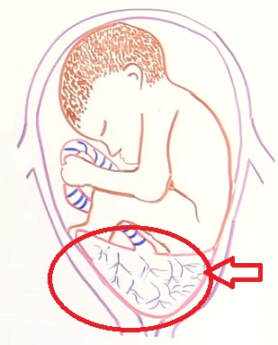 Placenta previa může způsobit závažné krvácení během těhotenství a porodu.