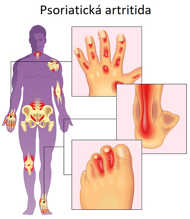 Psoriatická artritida - ilustrace