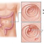 Střevní polypy – příznaky, příčiny, diagnostika a léčba polypů