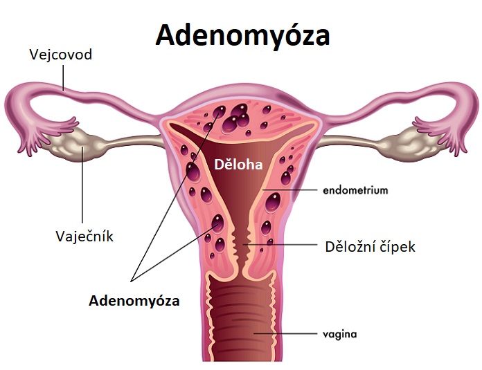 Adenomyóza - ilustrace