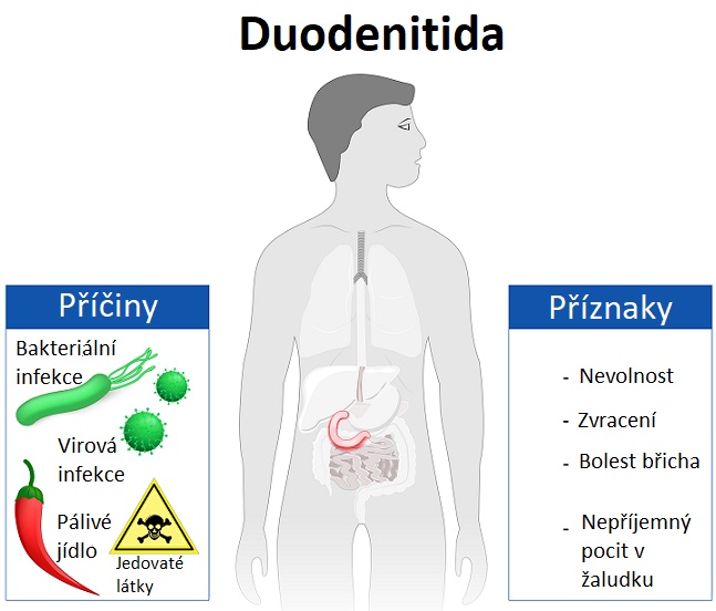 Duodenitida neboli zánět dvanáctníku - ilustrace