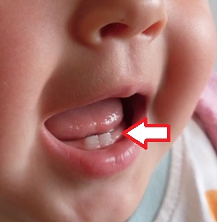 Esenciální oleje se dají použít při bolesti dásní malých dětí.